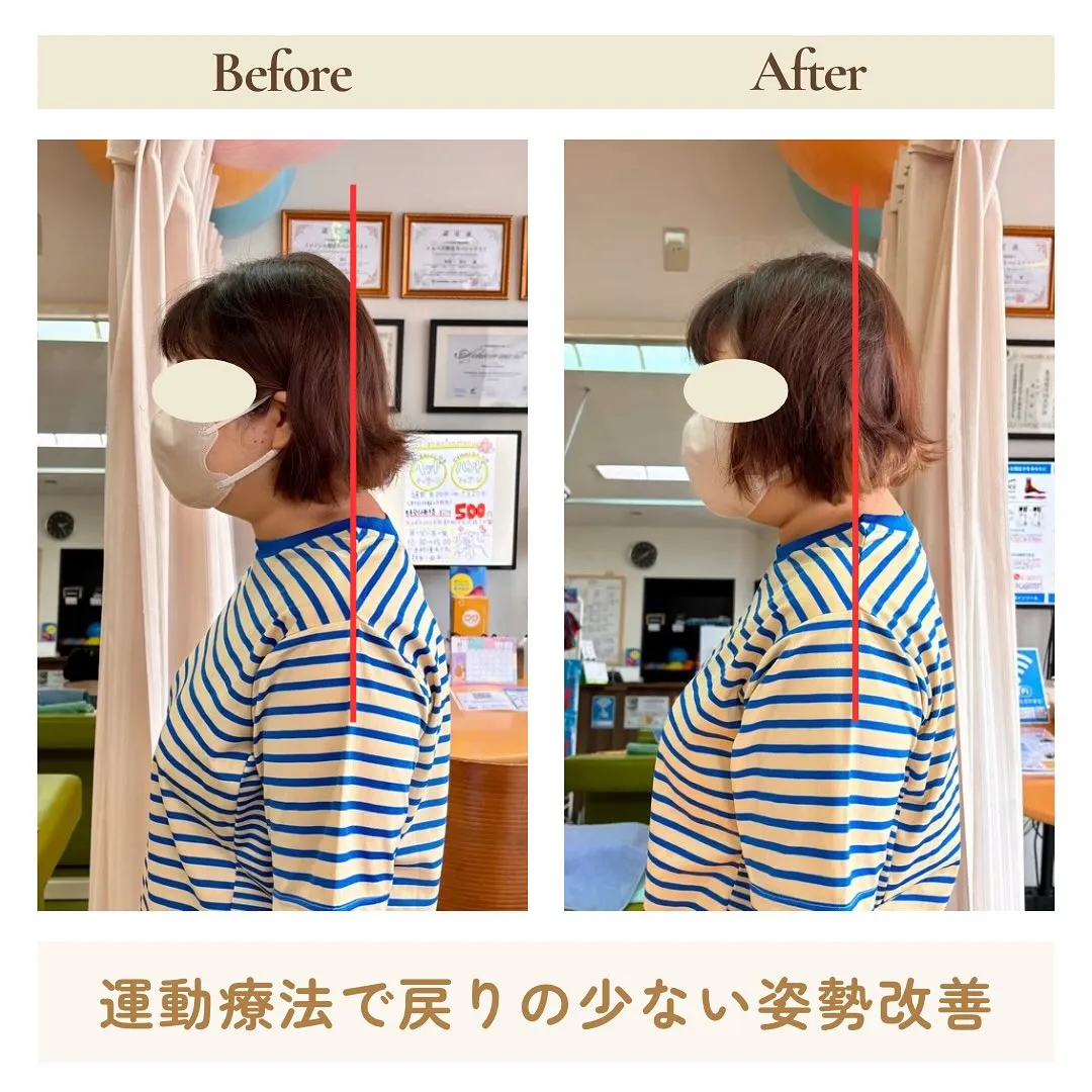 首の痛みでお困りの患者様がご来院されました。